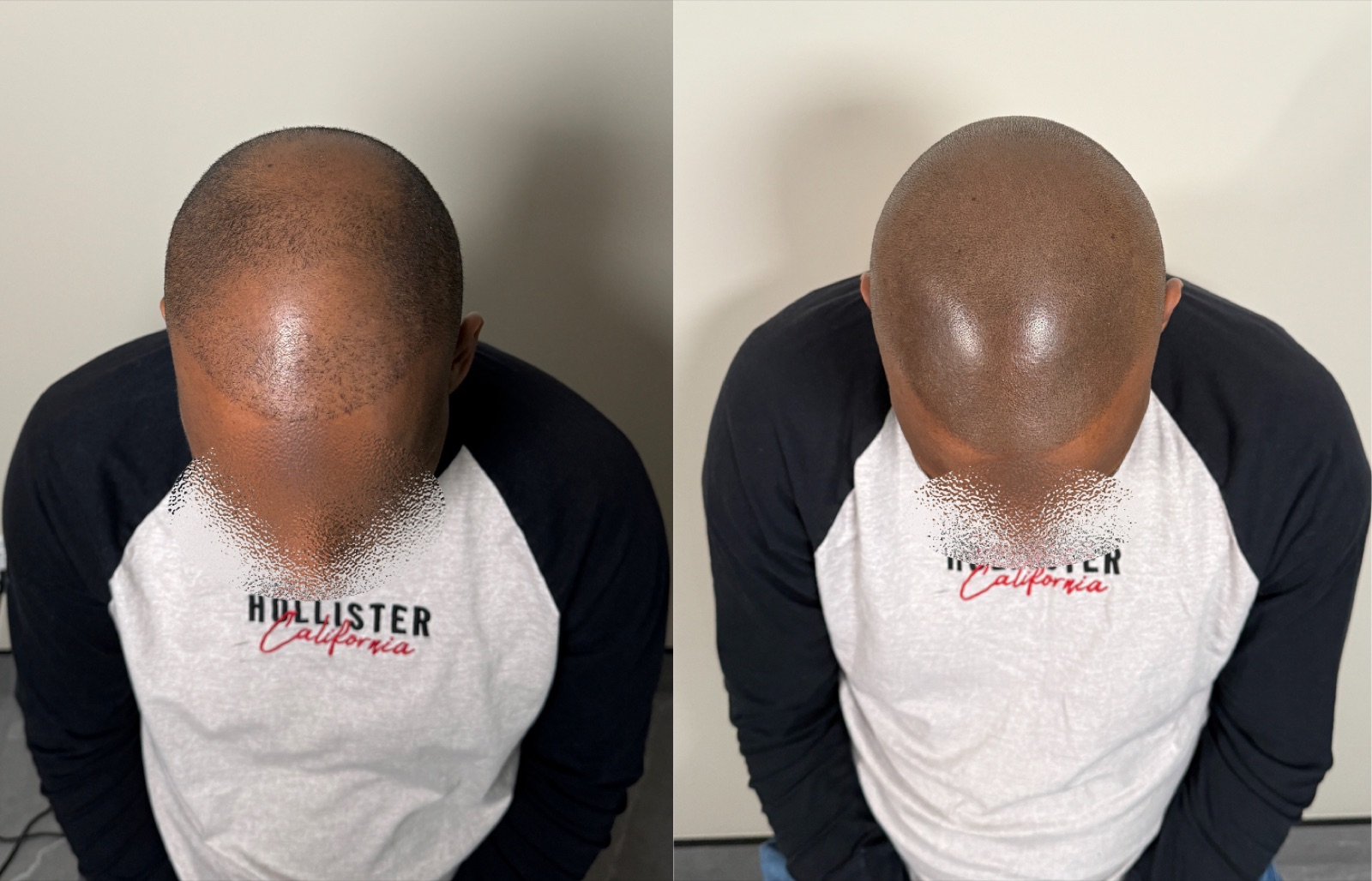 Shaved look SMP portfolio 20